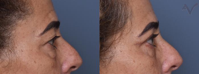 Before & After Upper Eyelid Surgery Case 375 Right Side View in Los Angeles, CA