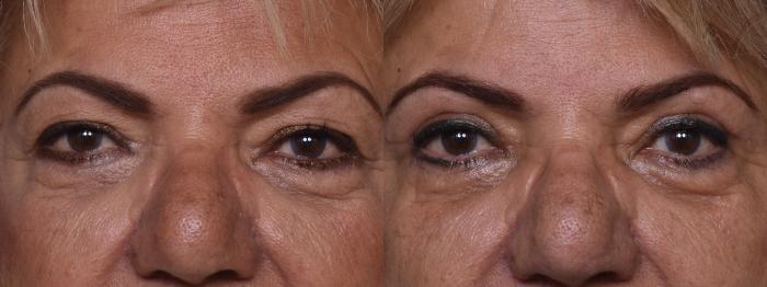 Before & After Upper Eyelid Surgery Case 383 Front View in Los Angeles, CA