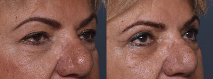 Before & After Upper Eyelid Surgery Case 383 Right Oblique View in Los Angeles, CA