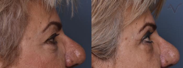 Before & After Upper Eyelid Surgery Case 383 Right Side View in Los Angeles, CA