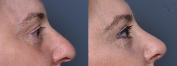 Before & After Upper Eyelid Surgery Case 392 Right Side View in Los Angeles, CA