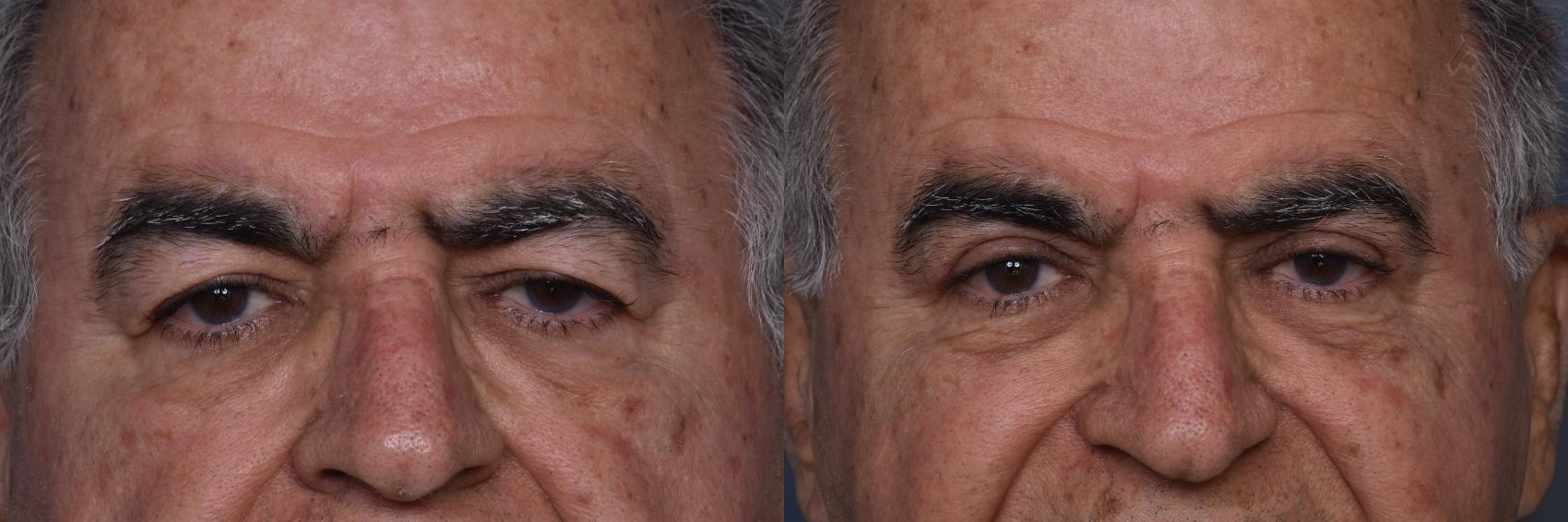 Before & After Upper Eyelid Surgery Case 441 Front View in Los Angeles, CA