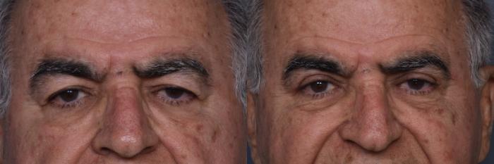 Before & After Upper Eyelid Surgery Case 441 Front View in Los Angeles, CA