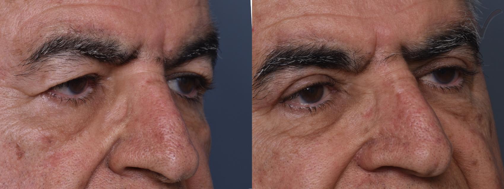 Before & After Upper Eyelid Surgery Case 441 Right Oblique View in Los Angeles, CA