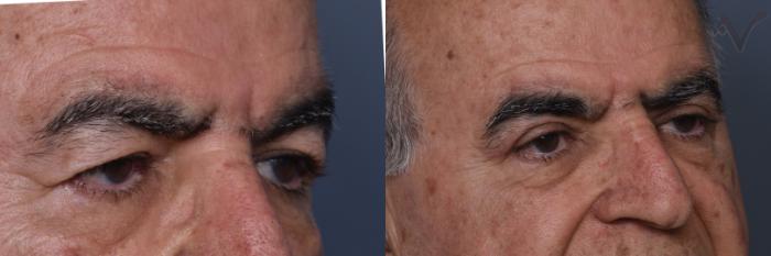 Before & After Upper Eyelid Surgery Case 441 Right Oblique View in Los Angeles, CA
