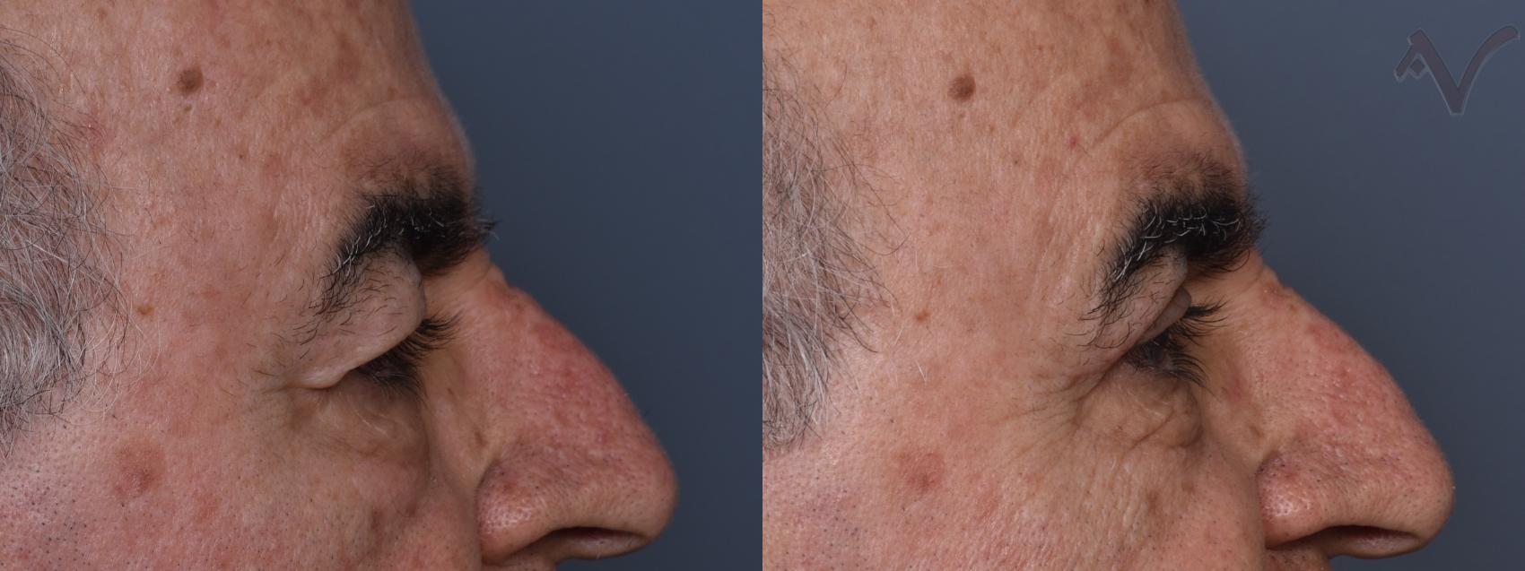 Before & After Upper Eyelid Surgery Case 441 Right Side View in Los Angeles, CA