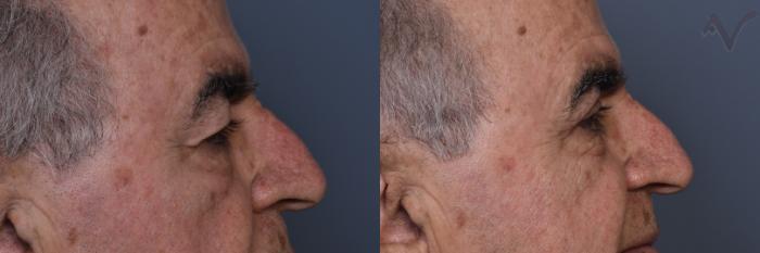 Before & After Upper Eyelid Surgery Case 441 Right Side View in Los Angeles, CA