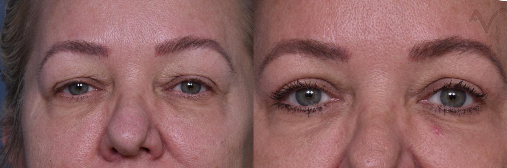 Before & After Upper Eyelid Surgery Case 442 Front View in Los Angeles, CA