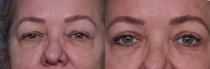 Before & After Upper Eyelid Surgery Case 442 Front View in Los Angeles, CA
