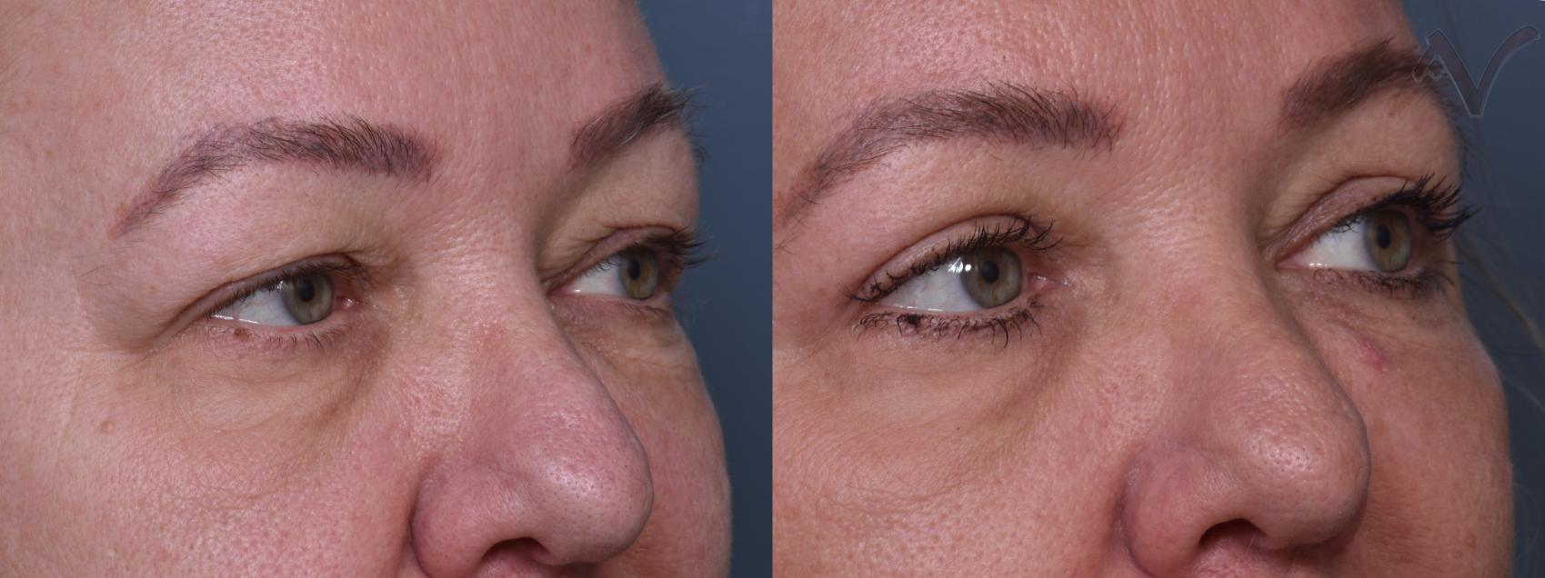 Before & After Upper Eyelid Surgery Case 442 Right Oblique View in Los Angeles, CA