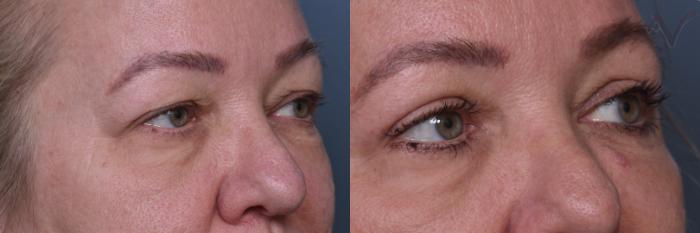 Before & After Upper Eyelid Surgery Case 442 Right Oblique View in Los Angeles, CA