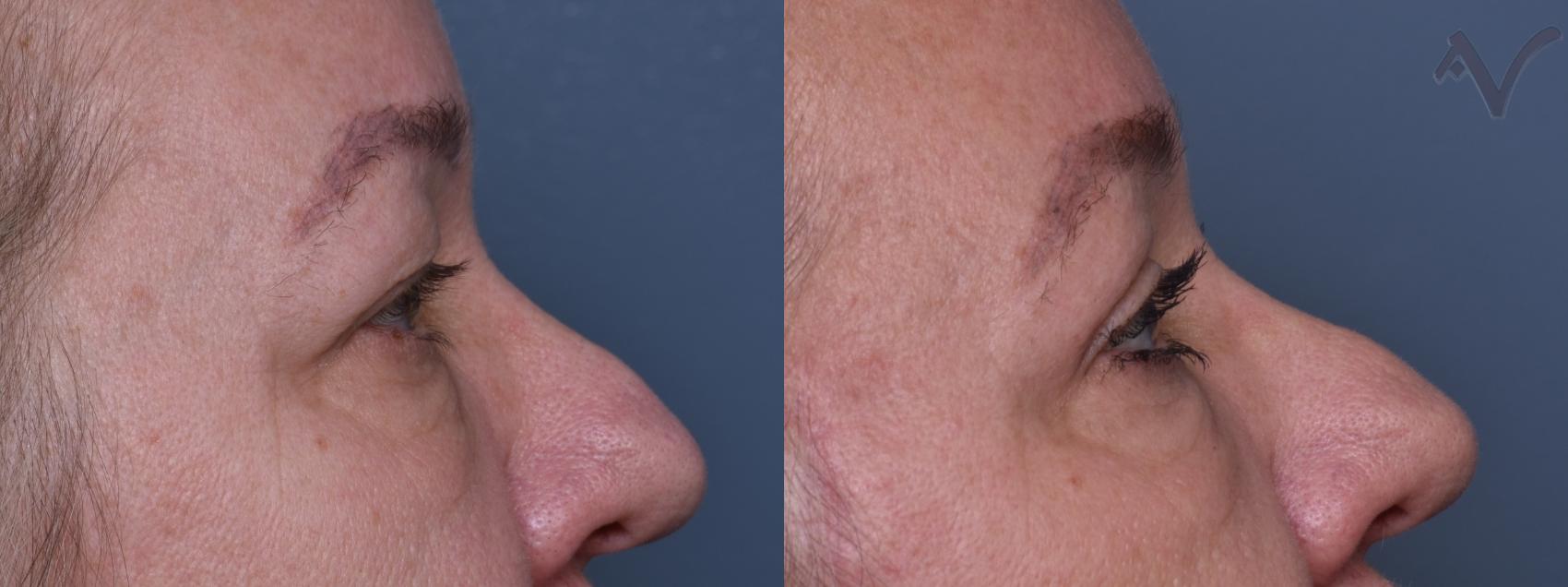 Before & After Upper Eyelid Surgery Case 442 Right Side View in Los Angeles, CA