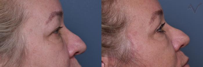 Before & After Upper Eyelid Surgery Case 442 Right Side View in Los Angeles, CA